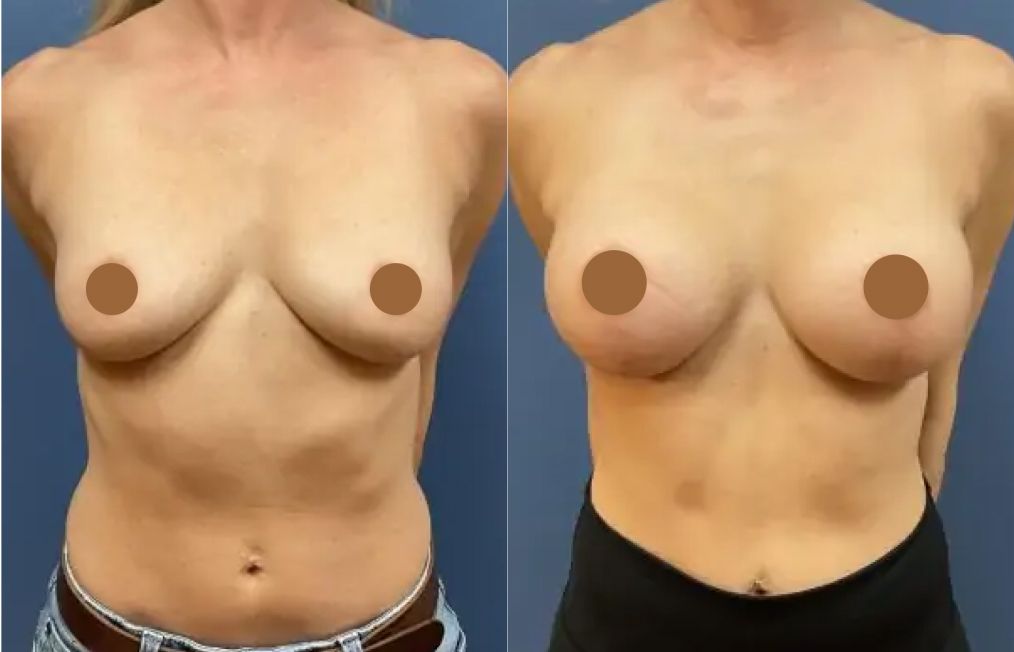 santa rosa plastic surgery patient before and after