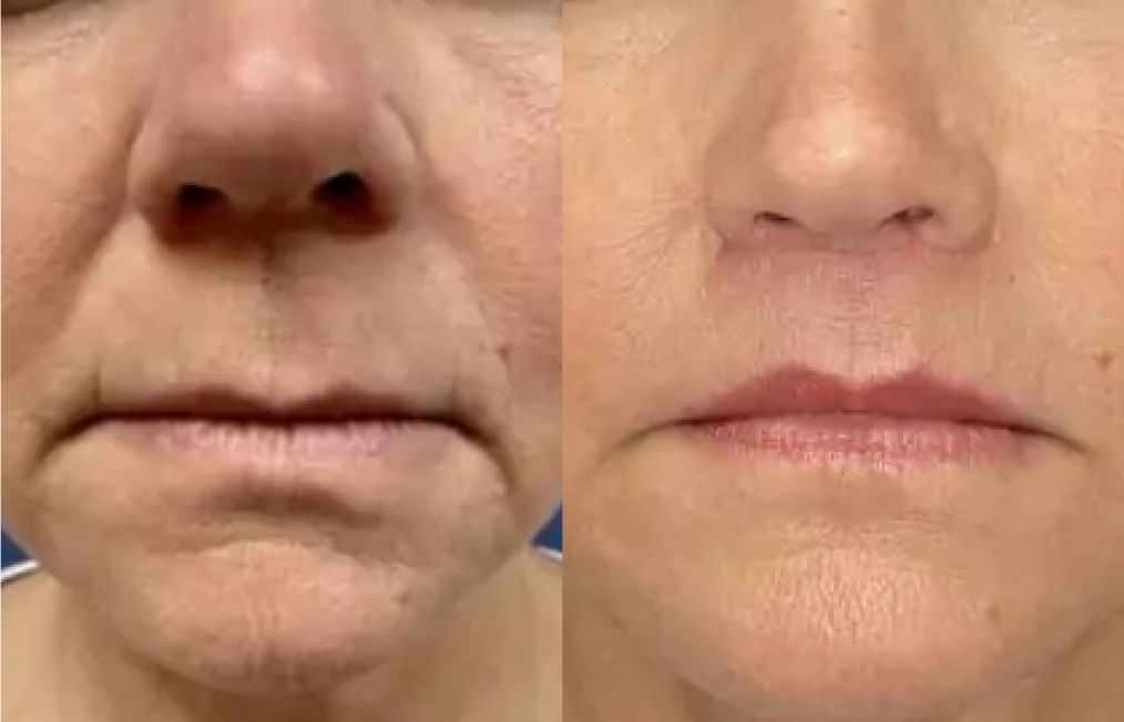 santa rosa plastic surgery patient before and after