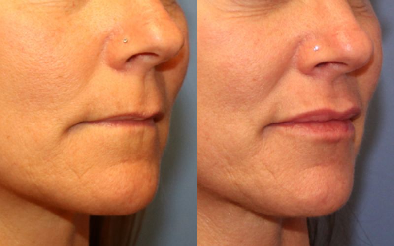 Before and after cosmetic lip enhancement procedure.