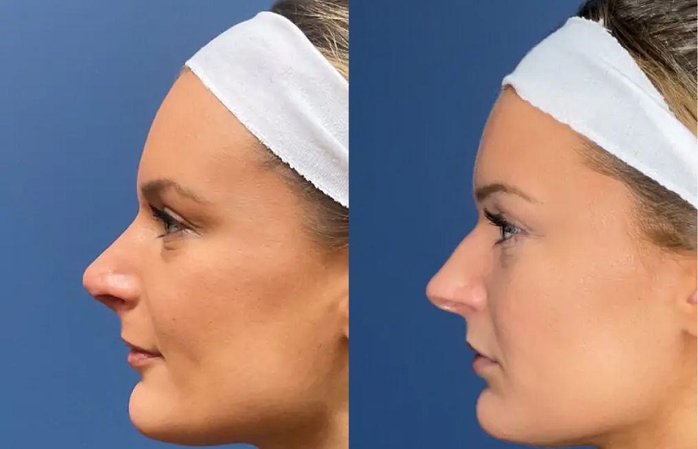 santa rosa plastic surgery patient before and after