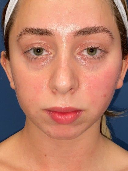 Chin Augmentation Before & After