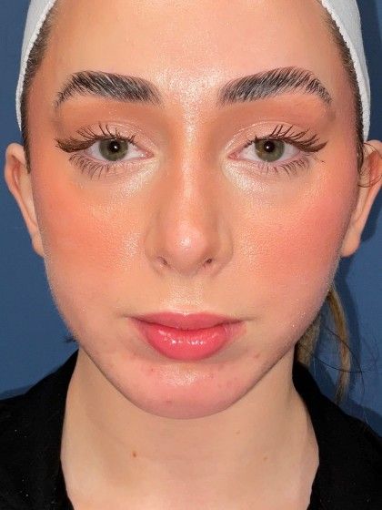 Chin Augmentation Before & After