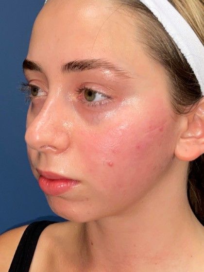 Chin Augmentation Before & After