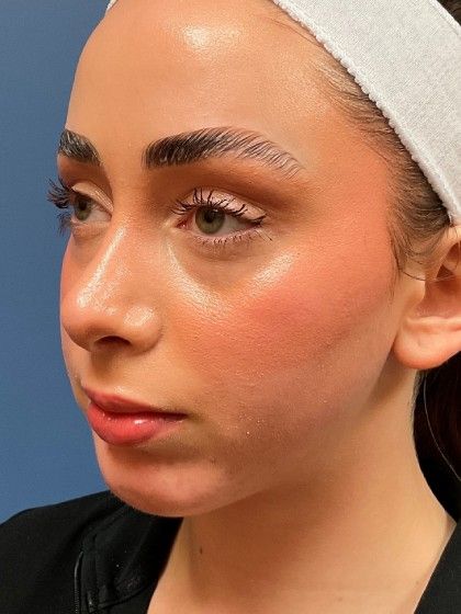 Chin Augmentation Before & After