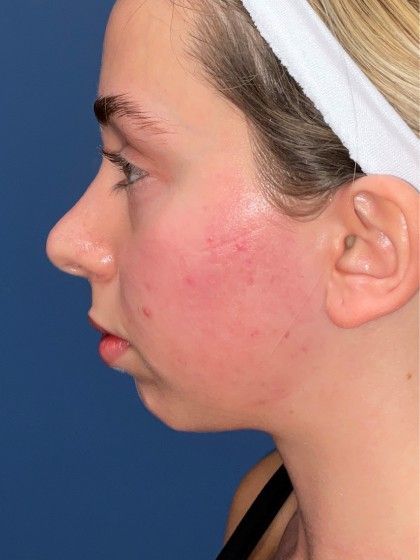 Chin Augmentation Before & After