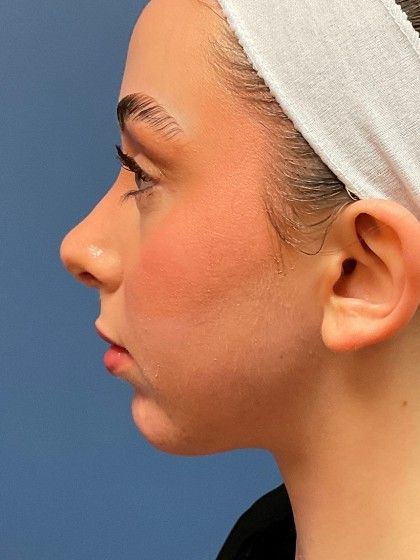 Chin Augmentation Before & After