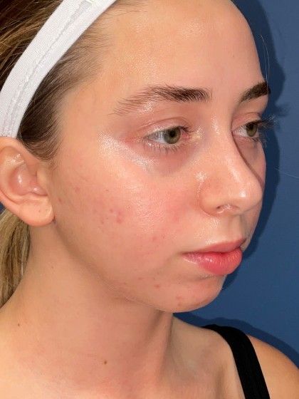 Chin Augmentation Before & After