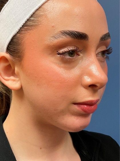 Chin Augmentation Before & After