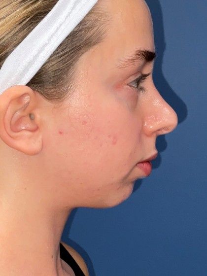 Chin Augmentation Before & After