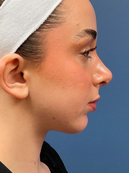 Chin Augmentation Before & After