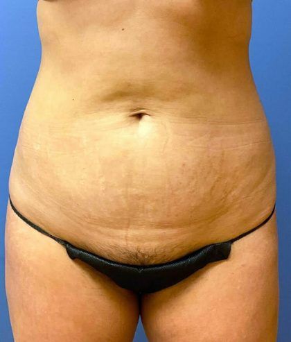 Tummy Tuck Before & After
