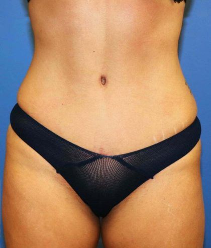 Tummy Tuck Before & After
