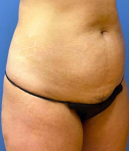 Tummy Tuck Before & After