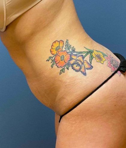 Tummy Tuck Before & After