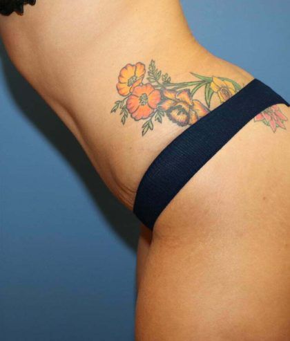 Tummy Tuck Before & After