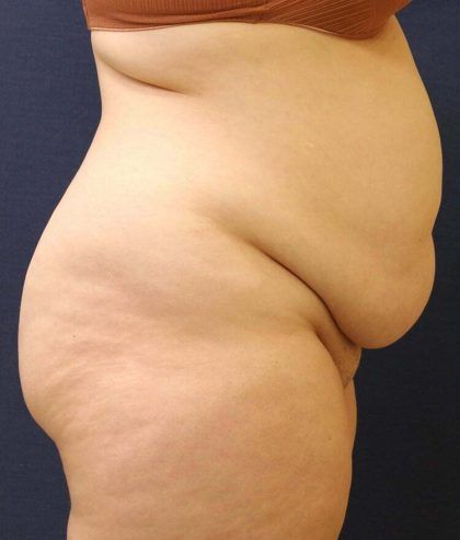 Tummy Tuck Before & After