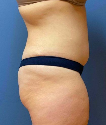 Tummy Tuck Before & After