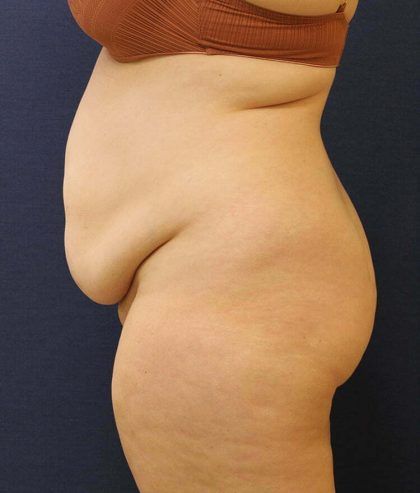 Tummy Tuck Before & After