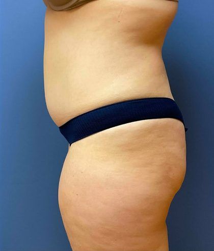 Tummy Tuck Before & After