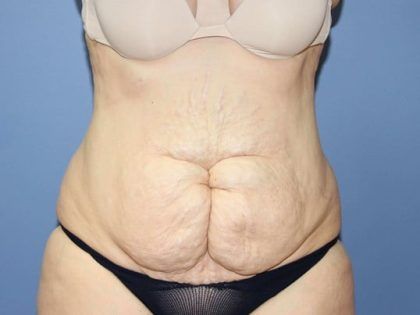 Tummy Tuck Before & After