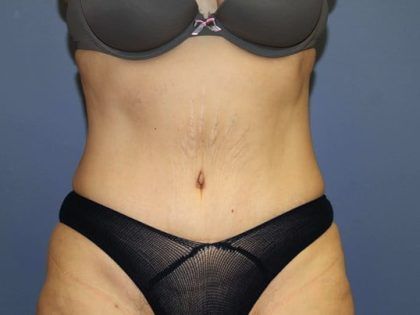Tummy Tuck Before & After