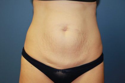 Tummy Tuck Before & After