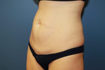 Tummy Tuck Before & After