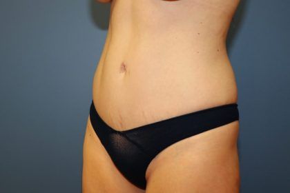 Tummy Tuck Before & After