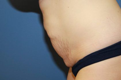 Tummy Tuck Before & After