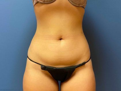Tummy Tuck Before & After