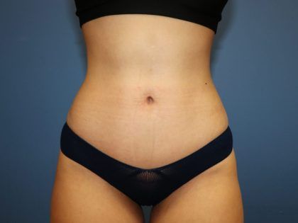 Tummy Tuck Before & After