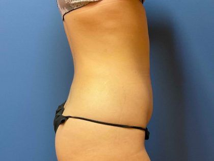 Tummy Tuck Before & After