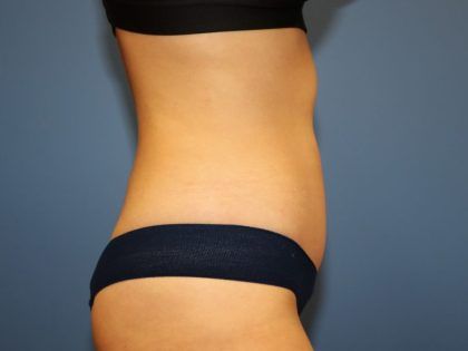 Tummy Tuck Before & After
