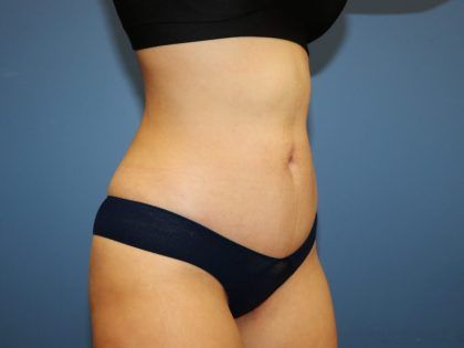 Tummy Tuck Before & After
