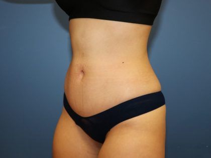 Tummy Tuck Before & After