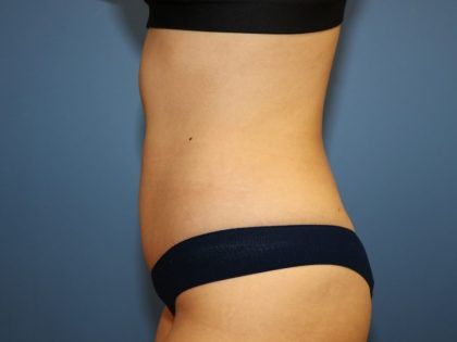 Tummy Tuck Before & After