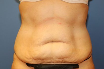 Tummy Tuck Before & After