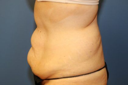Tummy Tuck Before & After