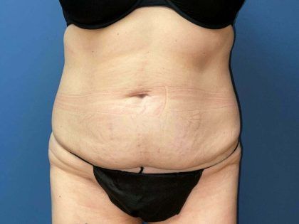 Tummy Tuck Before & After