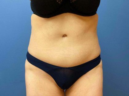 Tummy Tuck Before & After