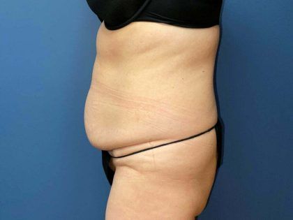 Tummy Tuck Before & After