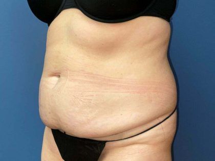 Tummy Tuck Before & After