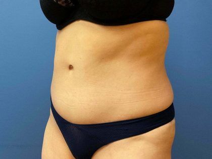 Tummy Tuck Before & After