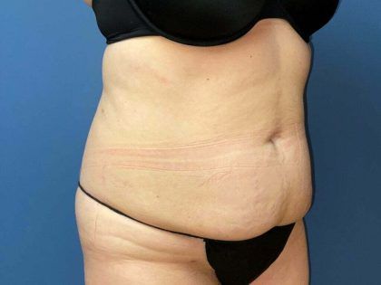Tummy Tuck Before & After