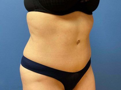 Tummy Tuck Before & After