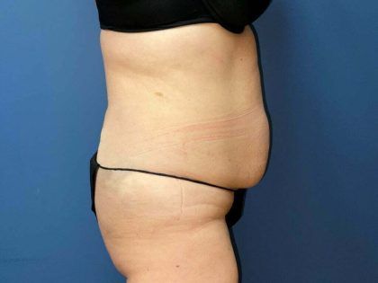 Tummy Tuck Before & After