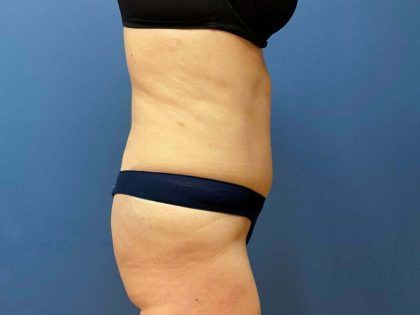 Tummy Tuck Before & After