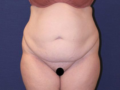 Tummy Tuck Before & After