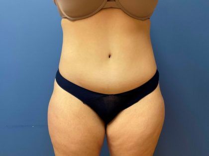 Tummy Tuck Before & After