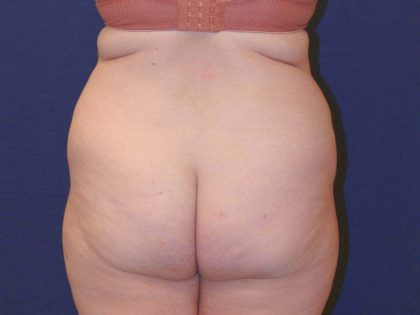 Tummy Tuck Before & After